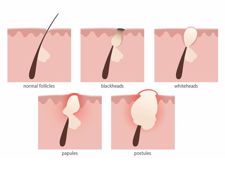 acne