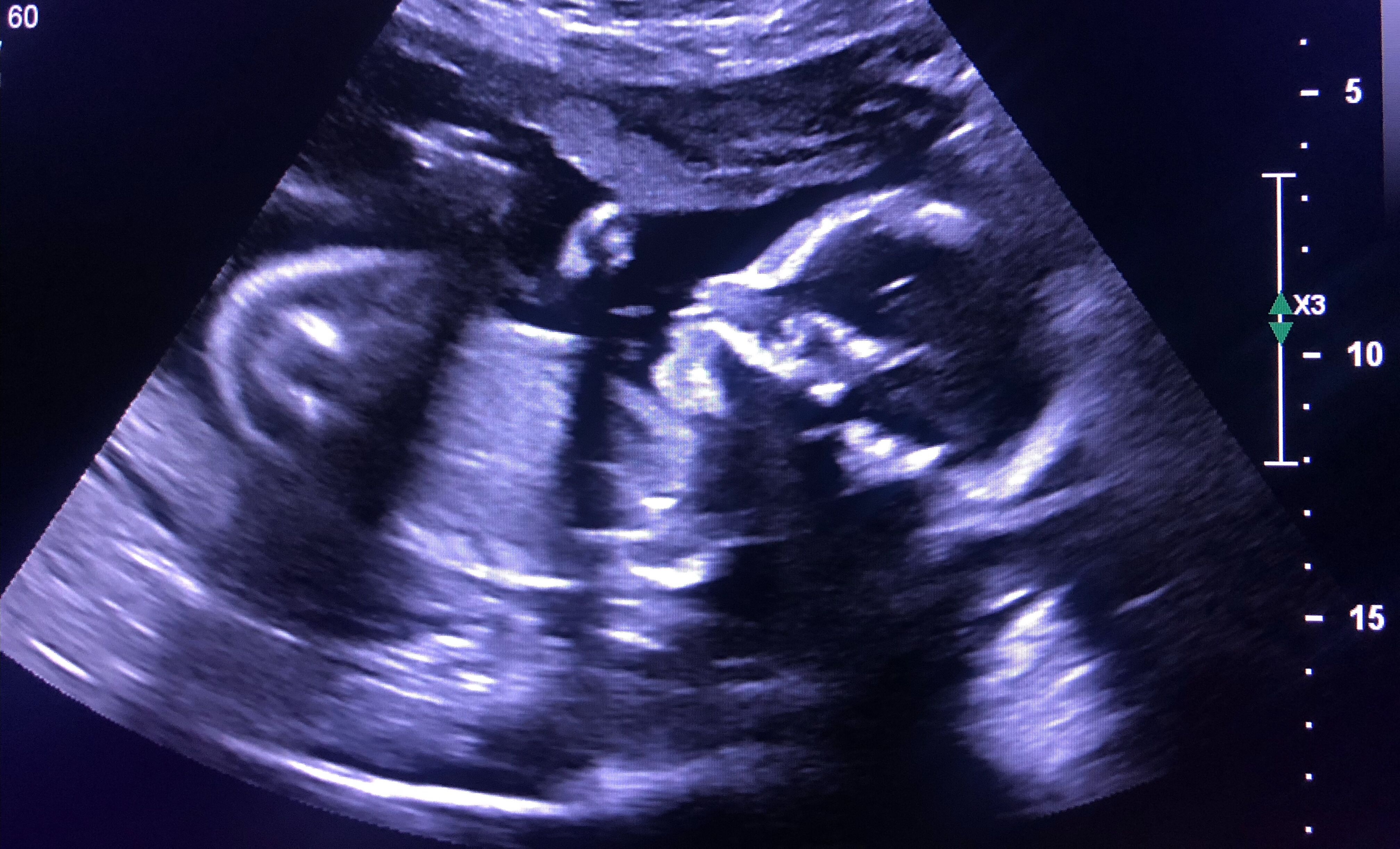 Picture of We're Pregnant!
