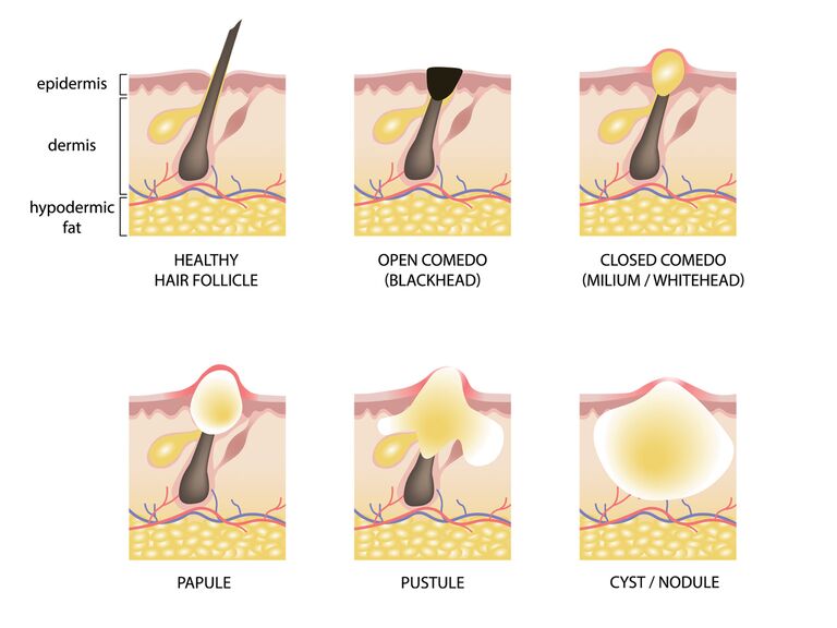 Graphic illustrating different types of acne