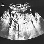 Baby H